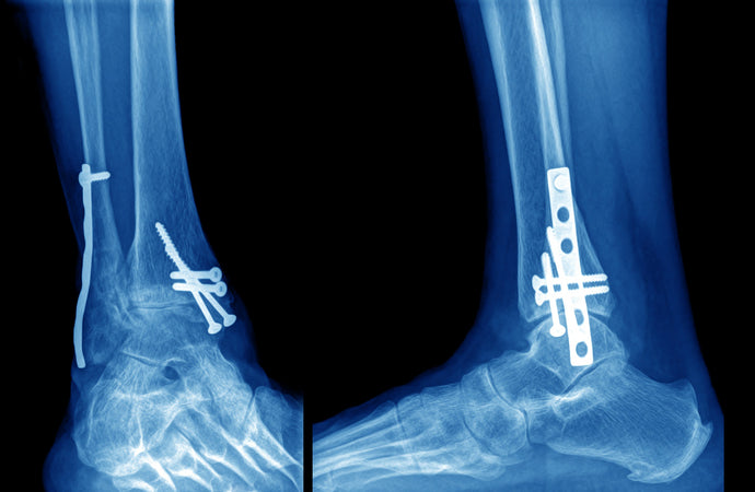 Syntellix: Disrupting the Medical Implant Titans with a Screw that Disappears